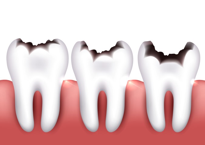 ¿Son enemigos nuestros dientes y el azúcar?