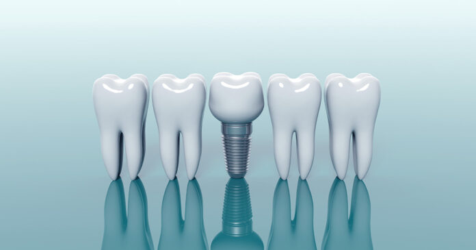 implante_dental_gira